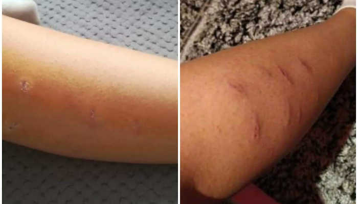 Batı Trakya’da köpeklerin saldırdığı kız hastanelik oldu